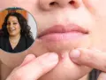 Pasta do zębów na pryszcze? Zrujnujesz cerę! Poznaj alternatywy