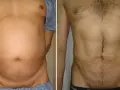 Liposukcja: Czy boli? Bezbolesny zabieg, kontrolowany dyskomfort