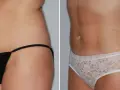 Liposukcja laserowa: Cena, ukryte koszty i jak sfinansować?