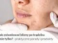 Pozbądź się śladów po pryszczach: skuteczne metody i porady