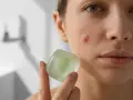 Pryszcz w 1 dzień? Skuteczne triki i czego unikać!