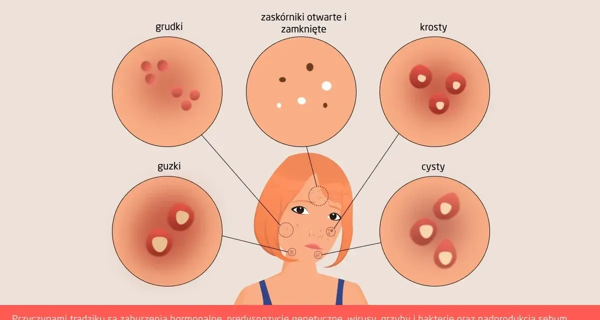 Dlaczego pryszcze na brodzie? Hormony, dieta, pielęgnacja rozwiązanie