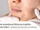 Pozbądź się śladów po pryszczach: skuteczne metody i porady