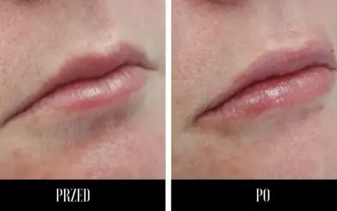 Usta kwasem hialuronowym: 6-12 miesięcy? Sprawdź, co wpływa!