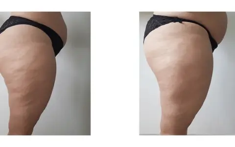 Endermologia Warszawa: Gdzie najlepiej i na co uważać?