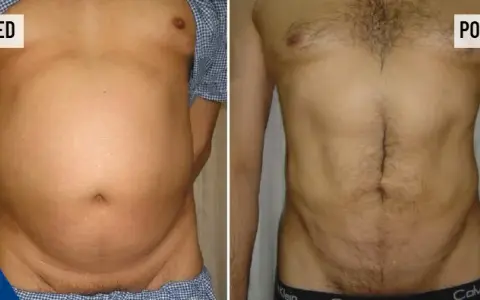 Liposukcja: Czy boli? Bezbolesny zabieg, kontrolowany dyskomfort