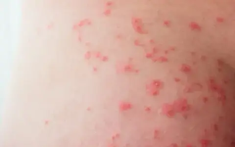 Krostki na pośladkach: Przyczyny i skuteczne sposoby na gładką skórę