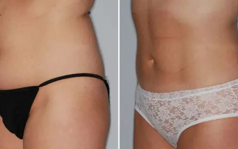 Liposukcja laserowa: Cena, ukryte koszty i jak sfinansować?