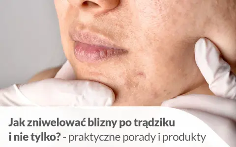 Pozbądź się śladów po pryszczach: skuteczne metody i porady
