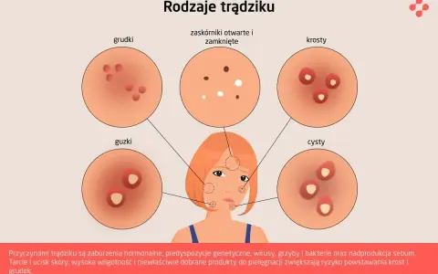 Dlaczego pryszcze na brodzie? Hormony, dieta, pielęgnacja rozwiązanie