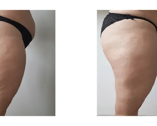 Endermologia Warszawa: Gdzie najlepiej i na co uważać?