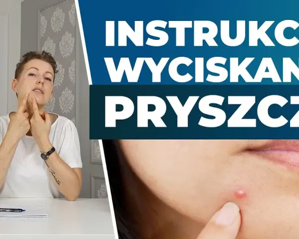 Jak wycisnąć pryszcza? Poradnik eksperta: Bezpiecznie i bez blizn