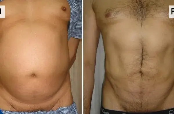 Liposukcja: Czy boli? Bezbolesny zabieg, kontrolowany dyskomfort