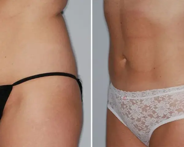 Liposukcja laserowa: Cena, ukryte koszty i jak sfinansować?