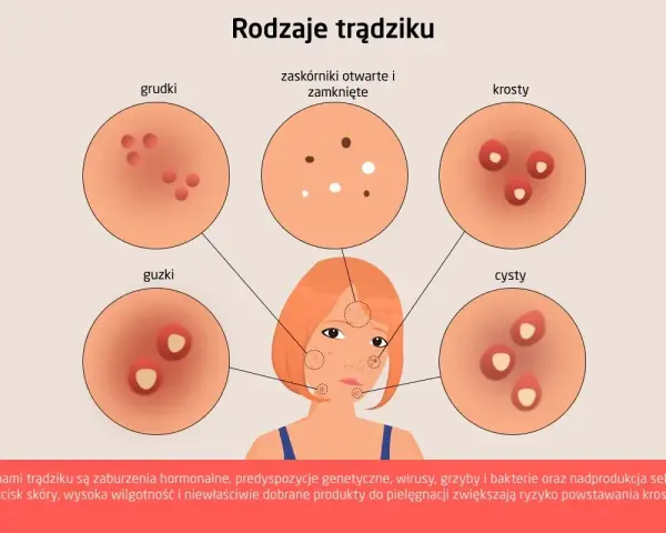 Dlaczego pryszcze na brodzie? Hormony, dieta, pielęgnacja rozwiązanie