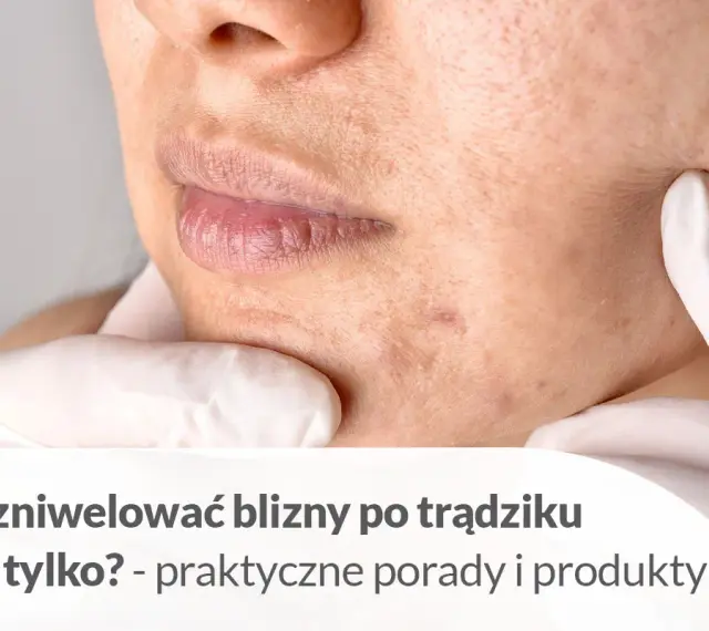 Pozbądź się śladów po pryszczach: skuteczne metody i porady