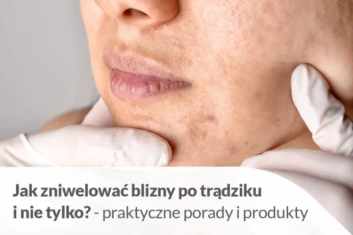 Pozbądź się śladów po pryszczach: skuteczne metody i porady