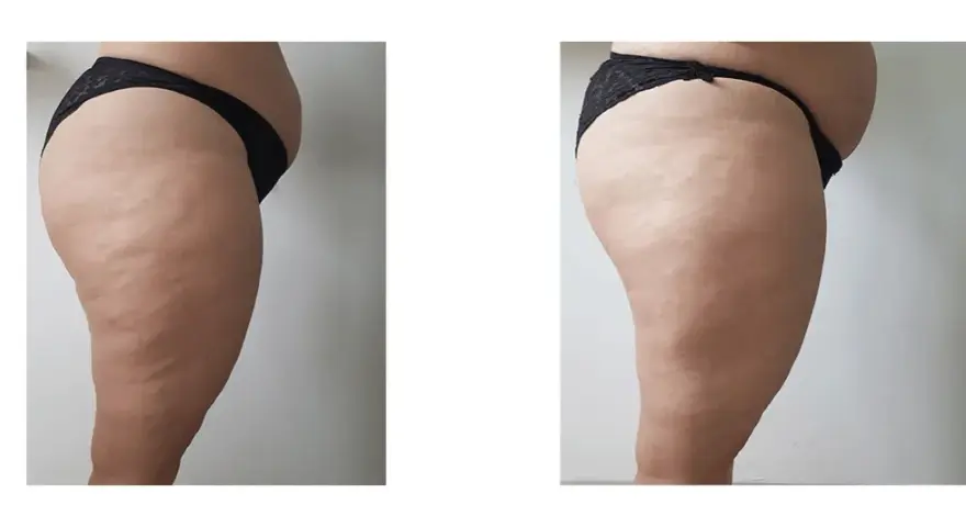 Endermologia Warszawa: Gdzie najlepiej i na co uważać?