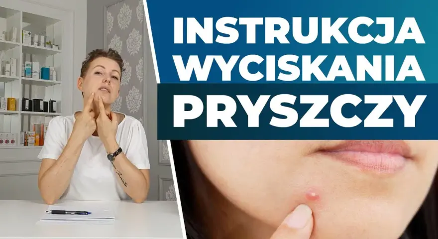 Jak wycisnąć pryszcza? Poradnik eksperta: Bezpiecznie i bez blizn
