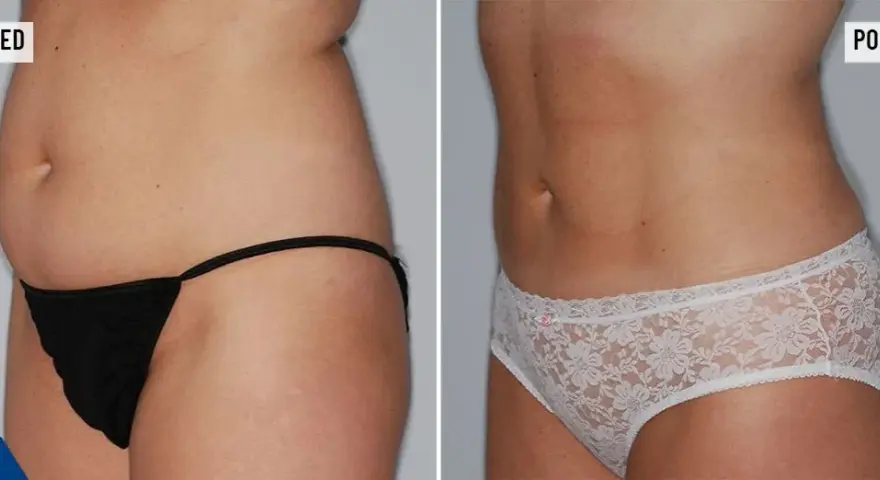 Liposukcja laserowa: Cena, ukryte koszty i jak sfinansować?