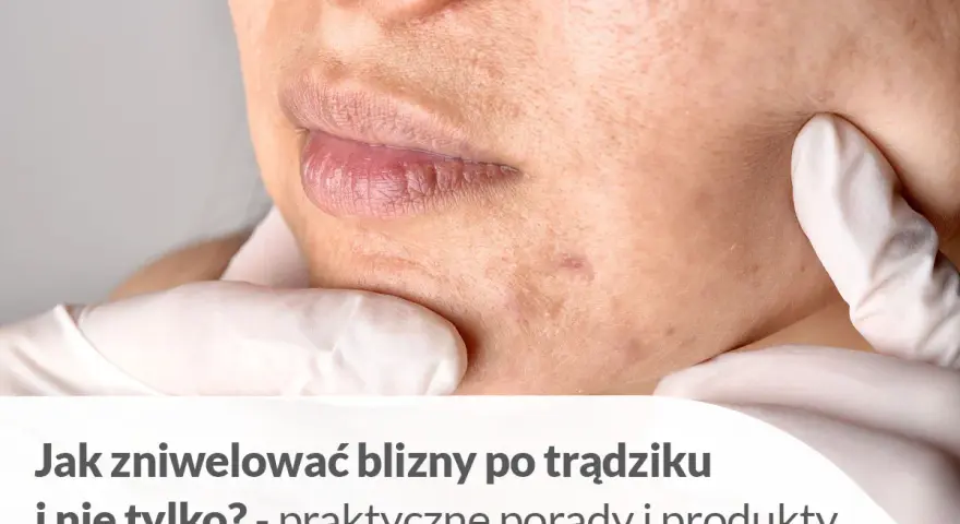 Pozbądź się śladów po pryszczach: skuteczne metody i porady