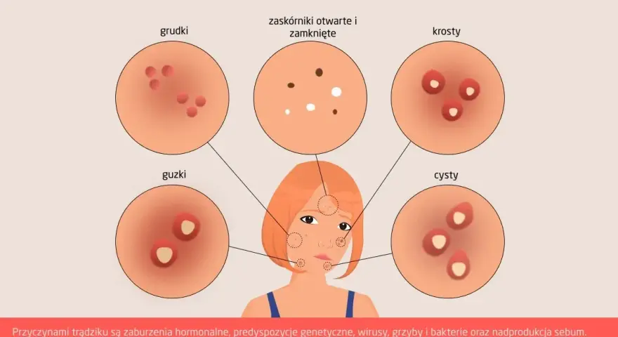 Dlaczego pryszcze na brodzie? Hormony, dieta, pielęgnacja rozwiązanie