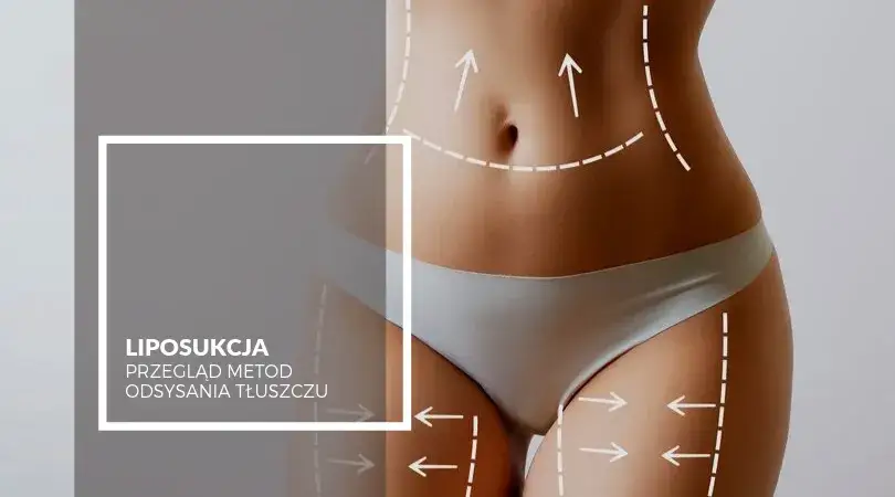 Zdjęcie Liposukcja: Co to jest? Przewodnik po odsysaniu tłuszczu