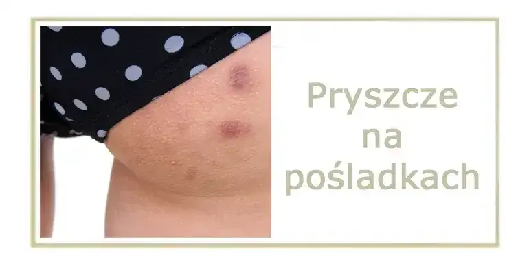 Zdjęcie Pryszcze na pupie? Skuteczne sposoby i porady ekspertki
